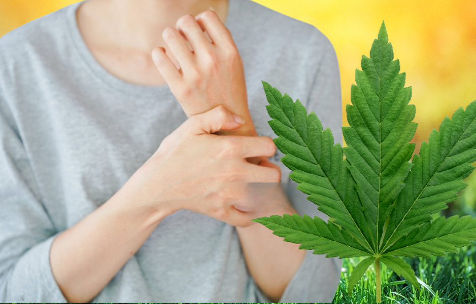 Medical Cannabis for Psoriasis